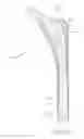 Fig. 22 - Prosthetic hip implants