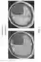 Fig. 02 - Intrathecal administration of autologous stem cells to treat intraventricular hemorrhage in premature infants