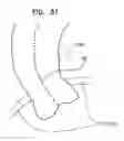 Fig. 22 - CONTROLLED ACTUATION AND DEPLOYMENT OF A MEDICAL DEVICE