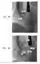 Fig. 24 - CONTROLLED ACTUATION AND DEPLOYMENT OF A MEDICAL DEVICE