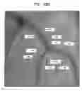 Fig. 30 - CONTROLLED ACTUATION AND DEPLOYMENT OF A MEDICAL DEVICE