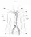 Fig. 01 - Expandable intra-aortic balloon pump sheath