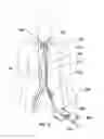 Fig. 04 - Expandable intra-aortic balloon pump sheath