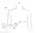 Fig. 06 - Implantable device for external urinary control