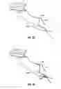 Fig. 40 - Meniscal repair device