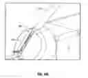 Fig. 76 - Meniscal repair device