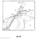 Fig. 77 - Meniscal repair device
