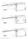 Fig. 02 - Method of implanting a subcutaneous defibrillator