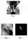 Fig. 02 - Stent and method for determining the position of a stent