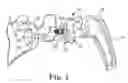 Fig. 02 - Glenoid implant anchor post