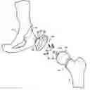 Fig. 01 - Hip socket with assembleable male ball shape having integrally formed ligament and female receiver and installation kit