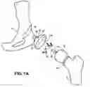 Fig. 02 - Hip socket with assembleable male ball shape having integrally formed ligament and female receiver and installation kit