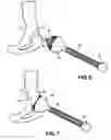 Fig. 07 - Hip socket with assembleable male ball shape having integrally formed ligament and female receiver and installation kit