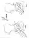 Fig. 08 - Hip socket with assembleable male ball shape having integrally formed ligament and female receiver and installation kit