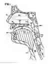 Fig. 02 - Pharyngeal wall treatment
