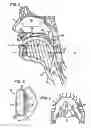 Fig. 03 - Pharyngeal wall treatment