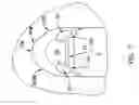 Fig. 06 - Pharyngeal wall treatment