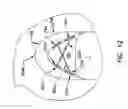 Fig. 11 - Pharyngeal wall treatment