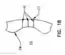 Fig. 17 - Pharyngeal wall treatment