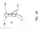 Fig. 18 - Pharyngeal wall treatment