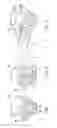 Fig. 06 - Fluid distributor and collection device with collapsible laterals and knuckles
