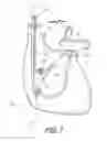Fig. 02 - DEVICE AND METHODS FOR DELIVERY OF BIOACTIVE MATERIALS TO THE RIGHT SIDE OF THE HEART