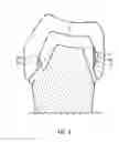 Fig. 06 -  METHOD OF DESIGNING A TOOTH REPLACEMENT PART, A METHOD OF PROCESSING A DESIGNED TOOTH REPLACEMENT PART, A TOOTH REPLACEMENT PART, AND A COMPUTER-READABLE MEDIUM