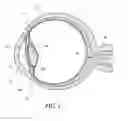 Fig. 02 - Ocular implant with therapeutic agents and methods thereof