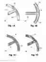 Fig. 02 - DUAL DRAINAGE PATHWAY SHUNT DEVICE