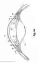 Fig. 06 - DUAL DRAINAGE PATHWAY SHUNT DEVICE
