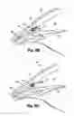 Fig. 07 - DUAL DRAINAGE PATHWAY SHUNT DEVICE