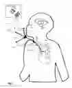 Fig. 03 - Systems, devices, and methods including infection-fighting and monitoring shunts
