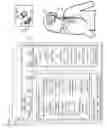 Fig. 04 - Systems, devices, and methods including infection-fighting and monitoring shunts