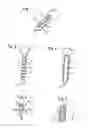 Fig. 02 - BONE ANCHORING ELEMENT WITH THREAD THAT CAN BE UNSCREWED