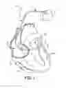Fig. 02 - Thin profile conductor assembly for medical device leads