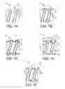 Fig. 06 - Thin profile conductor assembly for medical device leads