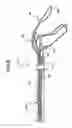 Fig. 07 - Detachable And Retrievable Stent Assembly