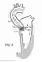 Fig. 09 - Prosthetic valve delivery system