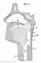 Fig. 02 - Implant systems and methods for treating obstructive sleep apnea