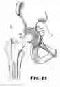 Fig. 09 - Containment system for constraining a prosthetic component