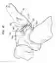 Fig. 09 - Method and apparatus for delivering a shape memory article to a surgical site