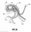 Fig. 27 - End-to-end anastomosis instrument and method for performing same