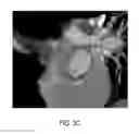 Fig. 05 - Method and system for dynamic pulmonary trunk modeling and intervention planning