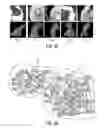 Fig. 10 - Method and system for dynamic pulmonary trunk modeling and intervention planning