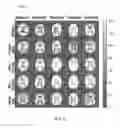Fig. 11 - Multi-phase pseudo-continuous arterial spin labeling
