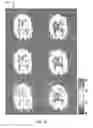 Fig. 20 - Multi-phase pseudo-continuous arterial spin labeling
