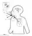 Fig. 03 - Systems, devices, and methods including infection-fighting and monitoring shunts