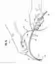 Fig. 06 - Insertion system and methods for nasogastric tubes