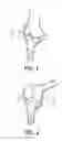 Fig. 02 - Device and method for installing femoral prosthetic knee joint
