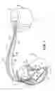Fig. 02 - Combined hemodynamic and EGM-based arrhythmia detection